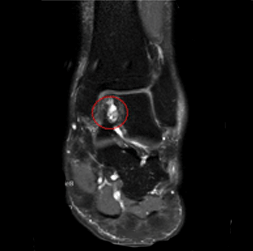 관절염환자 왼쪽발목 X-ray사진