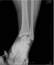 발목 불안정  X-ray사진
