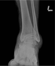 발목 관절염  X-ray사진